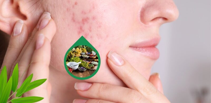 Khám phá 10 cách trị mụn tại nhà hiệu quả với nha đam, nghệ, rau diếp cá. Tìm hiểu công thức mặt nạ trị mụn, mẹo chăm sóc da để có làn da sạch mụn.