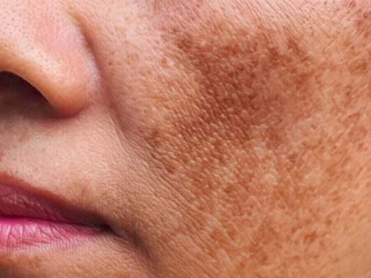 Hiểu về Nám Da - 7 Nguyên Nhân, Triệu Chứng và Cách Phòng Ngừa 1 Hình ảnh nám mảng trên da mặt