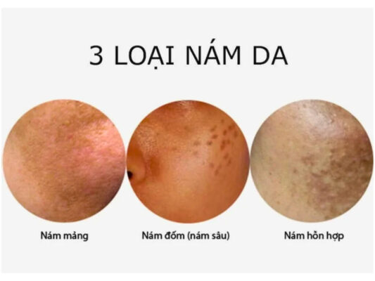 Hiểu về Nám Da - 7 Nguyên Nhân, Triệu Chứng và Cách Phòng Ngừa 3 Hình ảnh phân biệt nám mảng - nám chân sâu - nám hỗn hợp