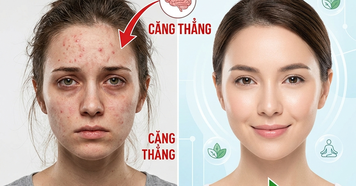 Stress và da tại sao căng thẳng gây mụn